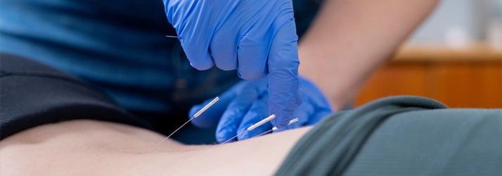 Close-up of a gloved hand inserting thin acupuncture needles into the lower back of a person