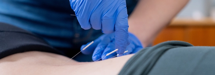 Dry needling being done on a patients back